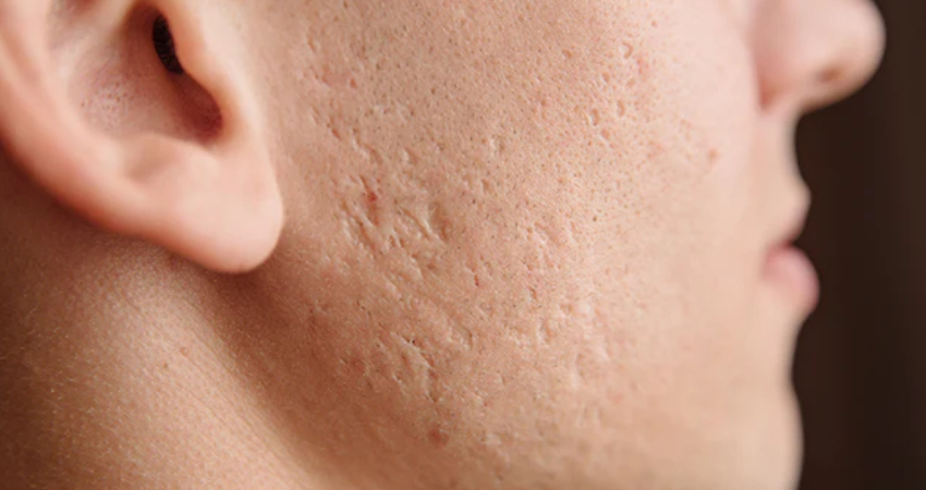 Acne Scar Treatment