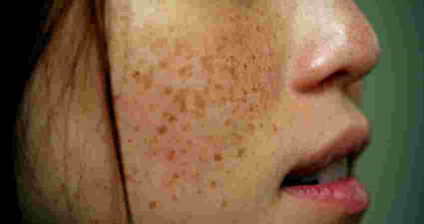 Pigmentation Treatment