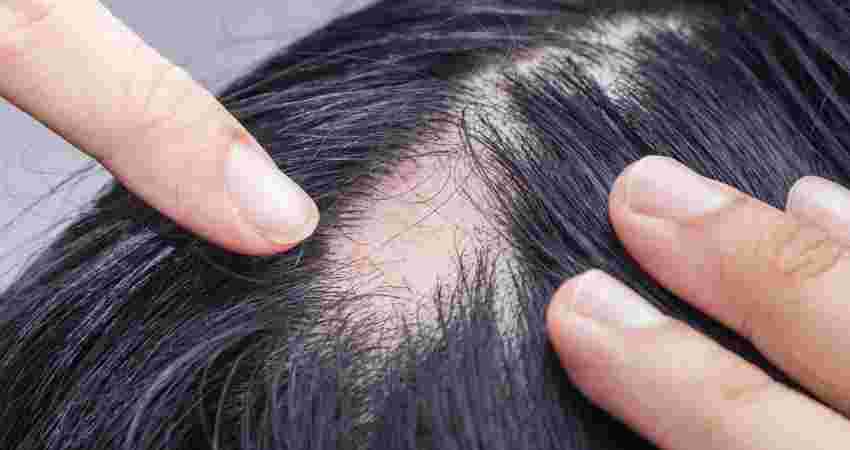 Hair Loss / Alopecia Areata Treatment
