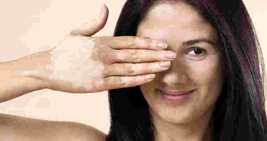 Vitiligo Treatment at Root Clinic