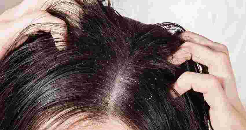Dandruff Treatment at Root Clinic