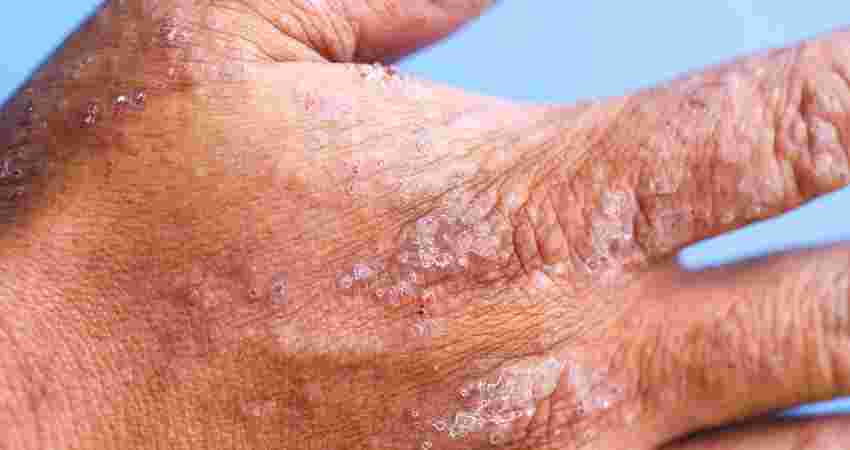 Eczema / Atopic Dermatitis Treatment