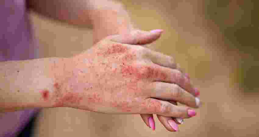 Rashes Treatment